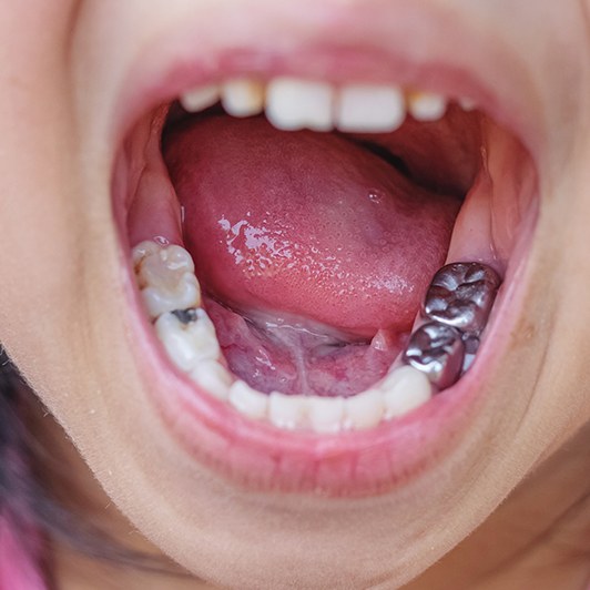 Child doing tongue tie aftercare exercises