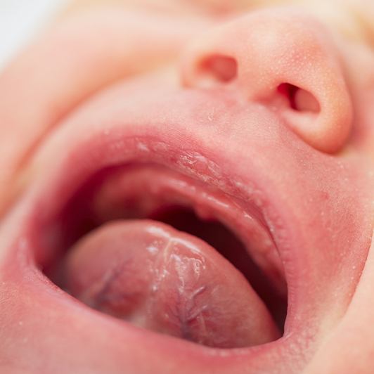 Closeup of crying baby with tongue tie