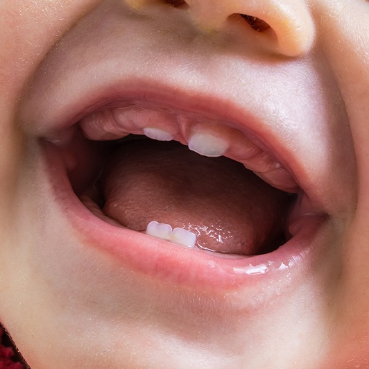 Closeup of baby with ankyloglossia