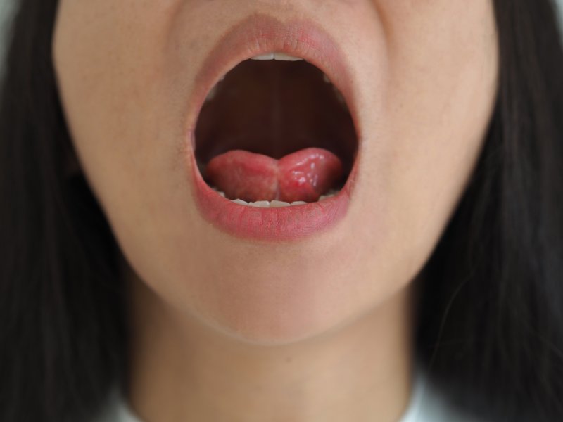 older girl with tongue-tie