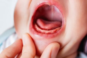 closeup of an infant’s mouth for infant acid reflux