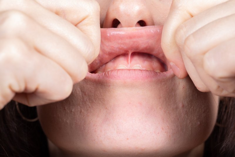 close-up of someone exposing their frenulum