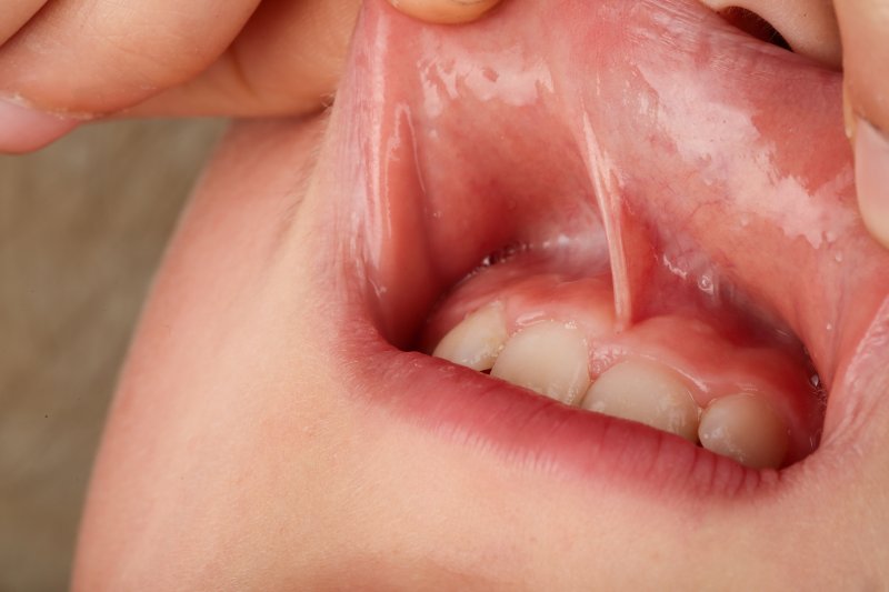 A toddler revealing their lip tie