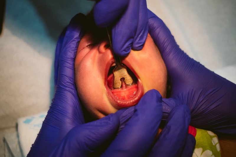 baby preparing for a frenectomy