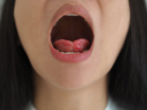 Adult woman opening her mouth to reveal a tongue tie