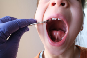 Child opening their mouth wide so pediatric dentist can examine a tongue-tie