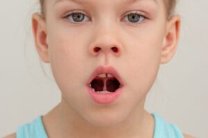 young child with a tongue tie