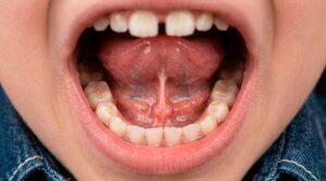 young child with a tongue tie